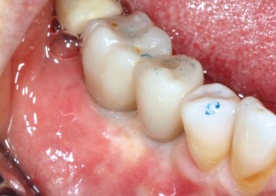 Final restoration at seven months post-operative