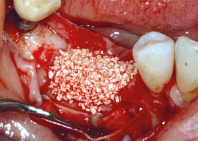 Application of cerabone mixed with autologus bone