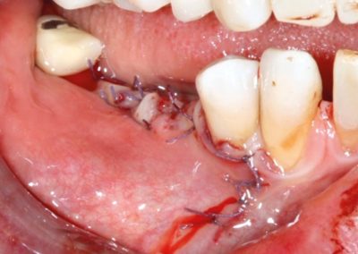 Jason membrane repositioned and suturing to achieve primary wound closure